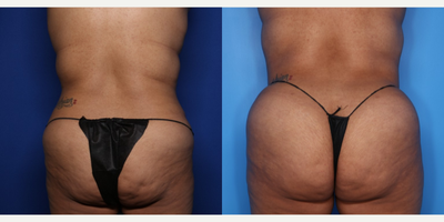 Case 1116 - 25-34 year old woman treated with Tummy Tuck
