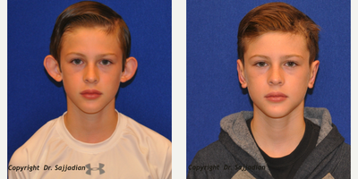 Case 11160 - Ear Surgery