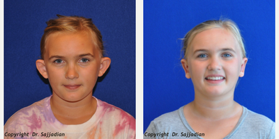 Case 11161 - Ear Surgery