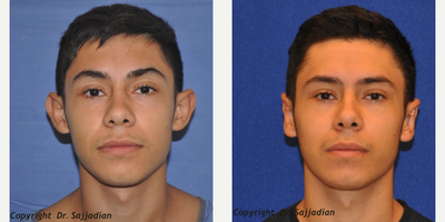 Case 11162 - Ear Surgery