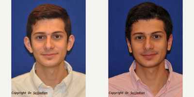 Case 11163 - Ear Surgery