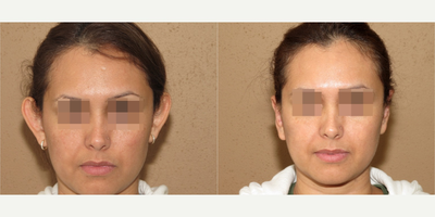 Case 11164 - 25-34 year old woman treated with Ear Surgery