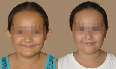 Case 11165 - Ear Surgery (Otoplasty) - Ear Pinback on a Young Child