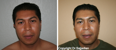 Case 11166 - Ear Surgery