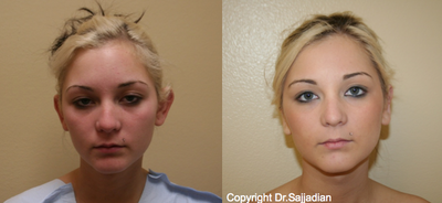 Case 11167 - Ear Surgery