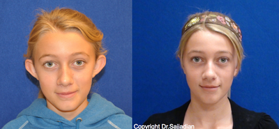 Case 11168 - Ear Surgery