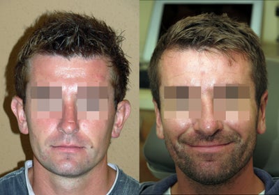 Case 11169 - Otoplasty or ear setback