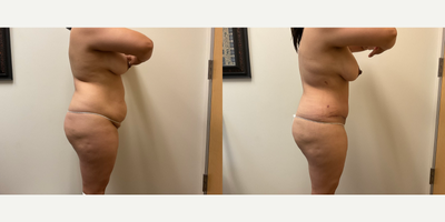 Case 1117 - Woman treated with Tummy Tuck, Liposuction