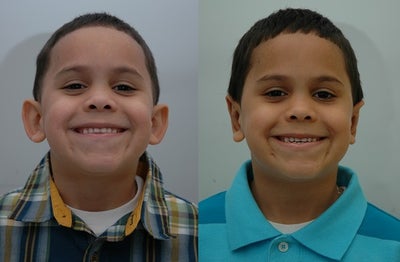 Case 11170 - Ear Surgery