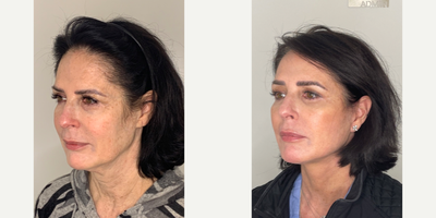 Case: 11171 - before and after photo of 55-64 year old woman treated with Facelift, Neck Lift, Eyelid Surgery, Facial Fat Transfer, CO2 Laser by Dilip D. Madnani, MD, FACS