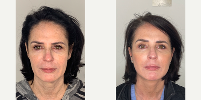 Case: 11172 - before and after photo of 55-64 year old woman treated with Facelift, Neck Lift, Eyelid Surgery, Facial Fat Transfer, CO2 Laser by Dilip D. Madnani, MD, FACS