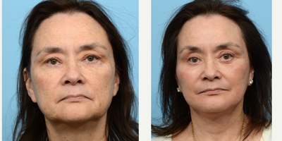 Case: 11173 - before and after photo of 55-64 year old woman treated with CO2 Laser by Jeffrey B. Wise, MD, FACS