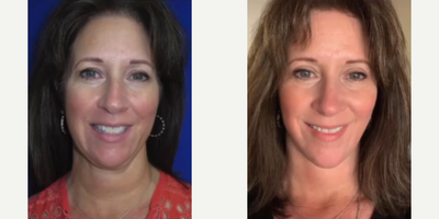 Case: 11174 - before and after photo of 55-64 year old woman treated with Neck Lift, Facelift, CO2 Laser by Raymond E. Lee, MD