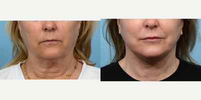Case: 11176 - before and after photo of 55-64 year old woman treated with CO2 Laser by Jeffrey B. Wise, MD, FACS