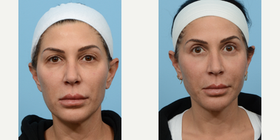 Case: 11177 - before and after photo of 45-54 year old woman treated with Eyelid Surgery, Double Eyelid Surgery, Facial Fat Transfer, CO2 Laser by Jeffrey B. Wise, MD, FACS