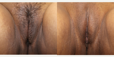 Case: 11178 - before and after photo of Woman treated with CO2 Laser by Wesley Anne Brady, MD