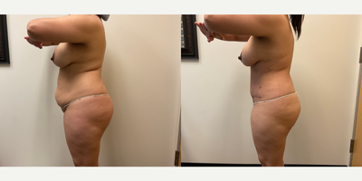 Case 1118 - Woman treated with Tummy Tuck, Liposuction