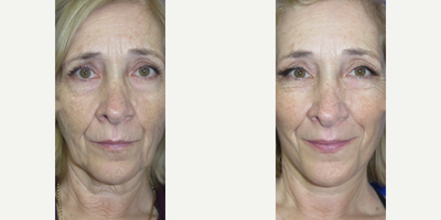 Case 11180 - 55-64 year old woman treated with Facelift, Neck Lift, CO2 Laser