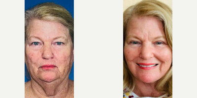 Case 11181 - Woman treated with Facelift, Skin Tightening, Eyelid Surgery, CO2 Laser