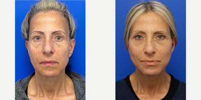 Case 11182 - 58 year old woman treated with CO2 Laser