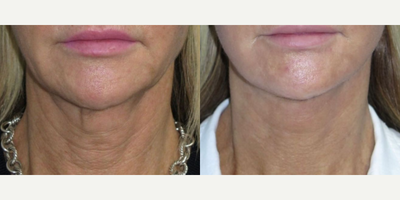 Case 11183 - Chin Liposuction, Facelift, Neck Lift, CO2 Laser