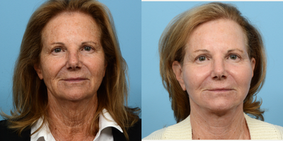 Case 11185 - 65-74 year old woman treated with Deep Plane Facelift, CO2 Laser, Facial Fat Transfer