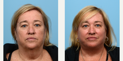 Case 11186 - 55-64 year old woman treated with Facelift, CO2 Laser