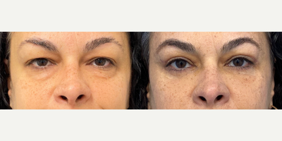 Case 11187 - 45-54 year old woman treated with Eyelid Surgery, Facial Fat Transfer, CO2 Laser