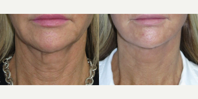 Case 11188 - Woman treated with Neck Lift, Facelift, CO2 Laser