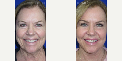 Case 11189 - Woman treated with Facelift, Neck Lift, CO2 Laser
