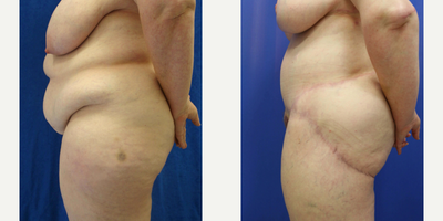 Case 1119 - 35-44 year old woman treated with Tummy Tuck