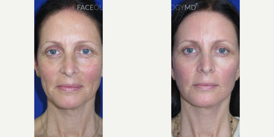 Case 11190 - Woman treated with CO2 Laser