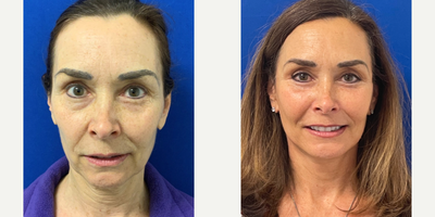 Case 11191 - 55-64 year old woman treated with Facelift, Neck Lift, Facial Fat Transfer, CO2 Laser