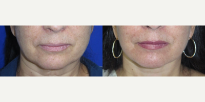 Case 11192 - Woman treated with CO2 Laser