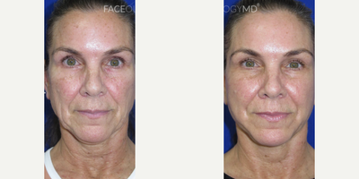 Case 11193 - Woman treated with CO2 Laser, Facial, Neck Lift