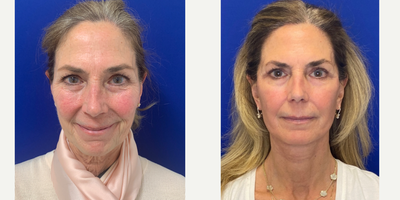 Case 11194 - 55-64 year old woman treated with Facelift, Neck Lift, Eyelid Surgery, CO2 Laser