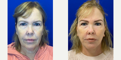 Case 11195 - 55-64 year old woman treated with Facelift, Neck Lift, CO2 Laser