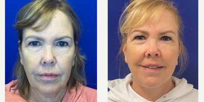 Case 11196 - 55-64 year old woman treated with Facelift, Neck Lift, Facial Fat Transfer, CO2 Laser