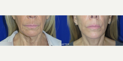 Case 11197 - Woman treated with CO2 Laser, Facelift