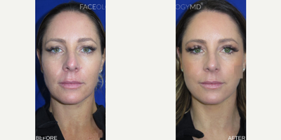 Case 11198 - Woman treated with Eyelid Surgery, CO2 Laser, Profound RF