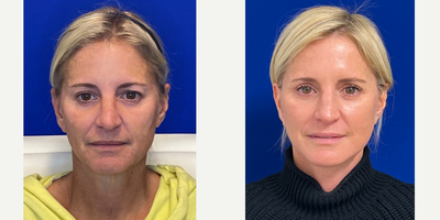 Case 11199 - 51 year old woman treated with CO2 Laser