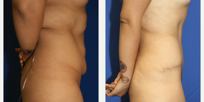 Case 1120 - Woman treated with Tummy Tuck