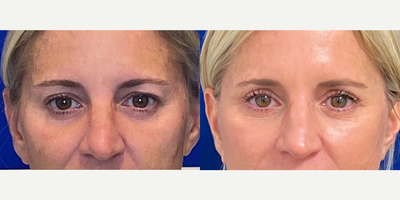 Case 11200 - 51 year old woman treated with CO2 Laser