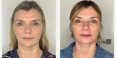 Case 11202 - 55-64 year old woman treated with Facelift, Neck Lift, Eyelid Surgery, Facial Fat Transfer, CO2 Laser