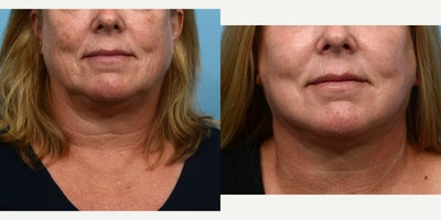 Case 11204 - 65-74 year old woman treated with CO2 Laser