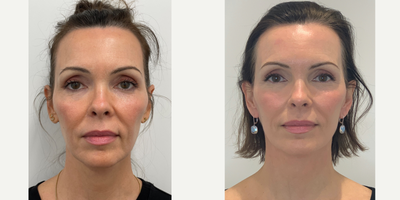 Case 11205 - 53 year old woman treated with CO2 Laser