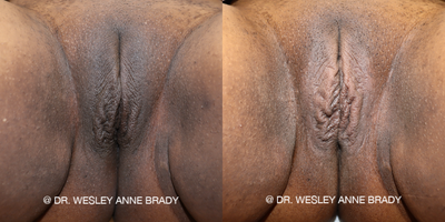 Case 11206 - 25-34 year old woman treated with CO2 Laser