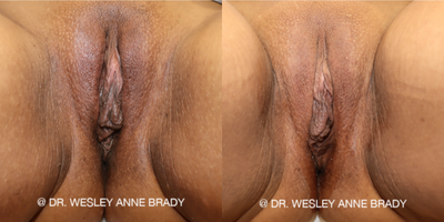 Case 11208 - 25-34 year old woman treated with CO2 Laser