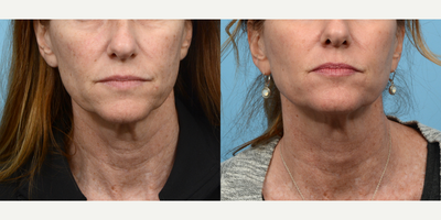 Case 11209 - 45-54 year old woman treated with CO2 Laser