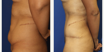 Case 1121 - Woman treated with Tummy Tuck